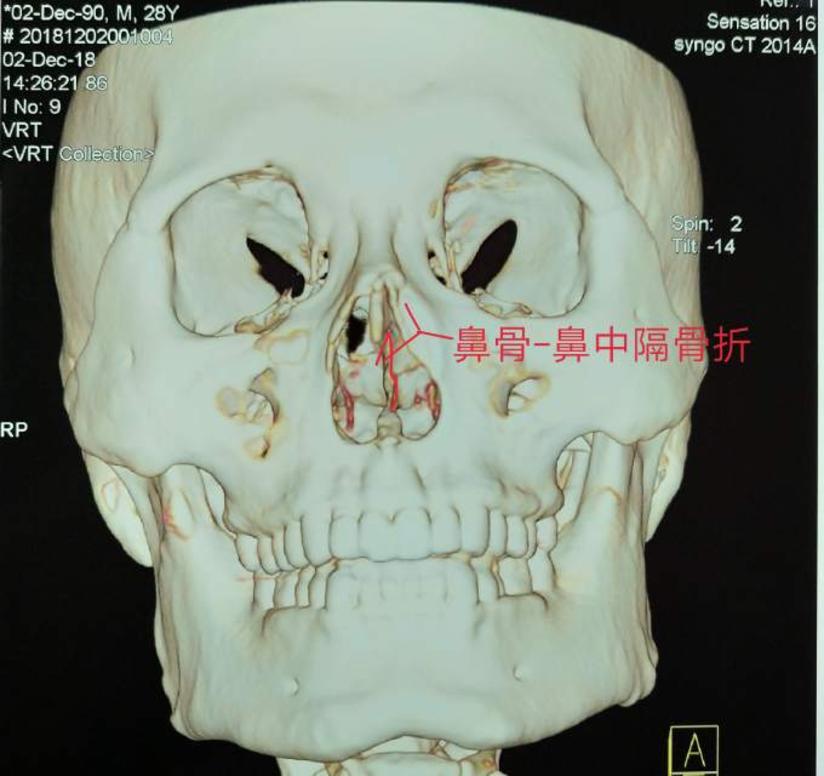 病案纪实 鼻骨联合鼻中隔骨折 健康号 微医